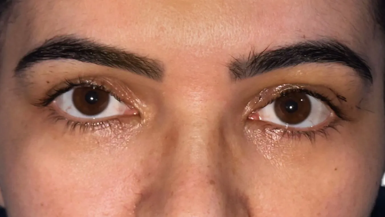 Olhar aberto e descansado após a blefaroplastia